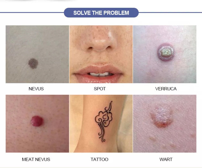 Plasma Pen Face Skin Care Mole Tattoo Removal Scars Skin Tag Removal