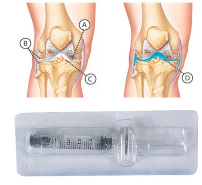 Noncrosslinked hyaluronic acid knee joint injection Lubricate arthritis